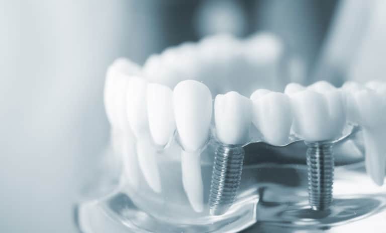 Nahaufnahme eines Zahnmodells, das eine Reihe künstlicher weißer Zähne zeigt, wobei zwei Zähne an sichtbaren Metallzahnimplantaten befestigt sind. Dies veranschaulicht die modernen All-on-4-Restaurationstechniken für feste Zähne an einem Tag. Der Hintergrund ist sanft verschwommen.