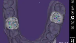 3D-Zahnscan der oberen Backenzähne mit farbigen Druckpunkten (blau, grün, gelb), die die Bisskraftverteilung anzeigen - Teil einer Digitalen Kiefergelenkmessung Kronberg. Werkzeugsymbole für Zahnbewegungen und mehr erscheinen auf einem violetten Hintergrund.