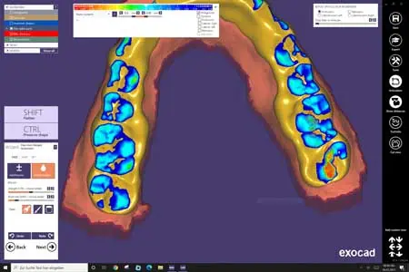 Ein digitales Zahnmodell in der exocad-Software zeigt eine farbkodierte Draufsicht der unteren Zähne und hebt die Druckpunkte des Bisses in Blau und Rot hervor. Die Benutzeroberfläche zeigt verschiedene Bedienelemente und Symbole auf der rechten Seite und Werkzeugoptionen auf der linken Seite.