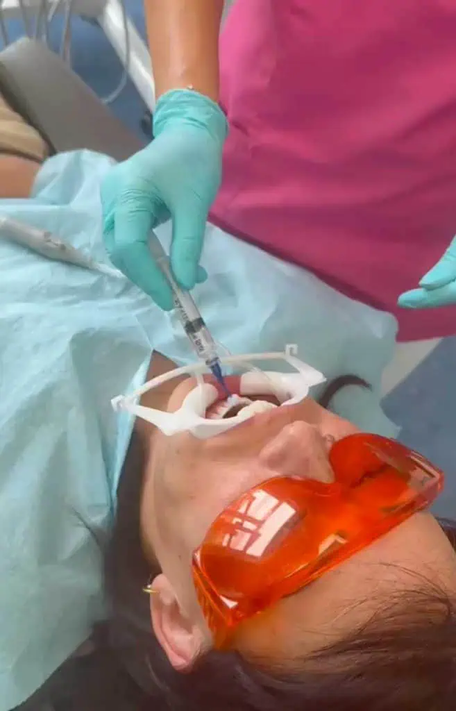 Ein Patient, der einen weißen Mundspreizer und eine orangefarbene Schutzbrille trägt, liegt auf einem Zahnarztstuhl. Ein Zahnarzt in rosa OP-Kleidung und türkisfarbenen Handschuhen trägt blaues Gel auf die Zähne des Patienten auf – ein üblicher Schritt bei der Zahnprophylaxe.