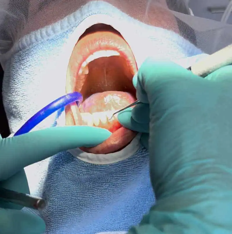 Ein Zahnarzt mit türkisfarbenen Handschuhen führt bei einem Patienten, der ein blaues Lätzchen trägt, eine zahnärztliche Vorsorgeuntersuchung durch und untersucht dabei die unteren Zähne mit einem Metallzahnstocher und einem Absaugschlauch.